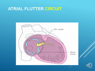 ATRIAL FLUTTER CIRCUIT
 