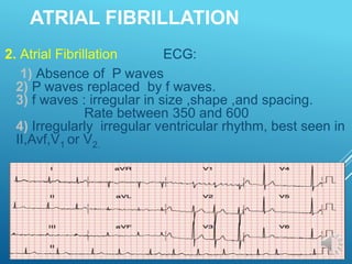 ATRIAL FIBRILLATION
2. Atrial Fibrillation ECG:
1) Absence of P waves
2) P waves replaced by f waves.
3) f waves : irregular in size ,shape ,and spacing.
Rate between 350 and 600
4) Irregularly irregular ventricular rhythm, best seen in
II,Avf,V1 or V2.
 