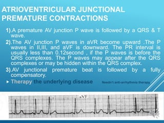 ATRIOVENTRICULAR JUNCTIONAL
PREMATURE CONTRACTIONS
1).A premature AV junction P wave is followed by a QRS & T
wave.
2).The AV junction P waves in aVR become upward .The P
waves in II,III, and aVF is downward. The PR interval is
usually less than 0.12second , if the P waves is before the
QRS complexes. The P waves may appear after the QRS
complexes or may be hidden within the QRS complex.
3).AV junctional premature beat is followed by a fully
compensatory.
 Therapy the underlying disease Needn’t anti-arrhythmia therapy.
 