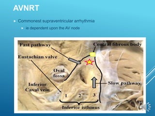 AVNRT
 Commonest supraventricular arrhythmia
 ie dependent upon the AV node
 