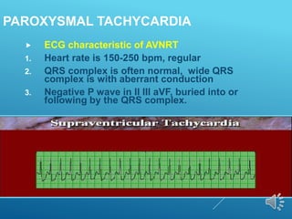 PAROXYSMAL TACHYCARDIA
 ECG characteristic of AVNRT
1. Heart rate is 150-250 bpm, regular
2. QRS complex is often normal, wide QRS
complex is with aberrant conduction
3. Negative P wave in II III aVF, buried into or
following by the QRS complex.
 