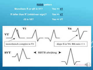 RBBB pattern
Monofasic R or qR in V1? Yes => VT
R taller than R' (rabbit-ear sign)? Yes => VT
rS in V6? Yes => VT
 
