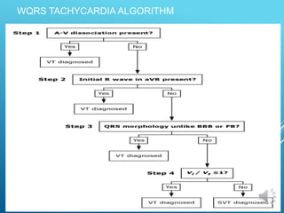 WQRS TACHYCARDIA ALGORITHM
 