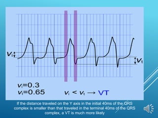 If the distance traveled on the Y axis in the initial 40ms of the QRS
complex is smaller than that traveled in the terminal 40ms of the QRS
complex, a VT is much more likely
 