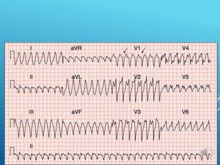 VENTRICULAR TACHYCARDIA
 