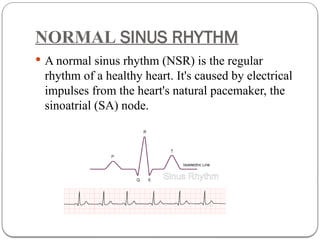 Sa Node Normal Rhythm Cardiac Arrhythmias for paramedical students. | PPTX