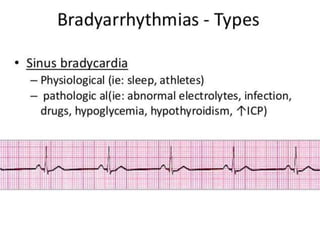 Arrhythmia 