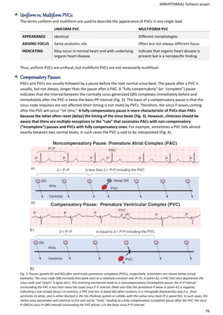 Arrhythmia: Mechanism, Classification, ECG features | PDF
