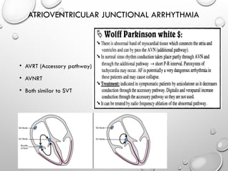Basics of Arrhythmia Medical Students2.pptx