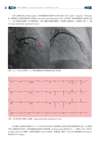 No.036THRS4 中華民國心律醫學會 ‧Taiwan Heart Rhythm Soclety‧ 中華民國 108 年 12 月出刊
　　由於心電圖呈現 de Winter pattern，值班醫師將患者視同 STEMI 治療，給予 Aspirin、Ticagrelor、與 Heparin
後，啟動緊急心導管發現病患左前降枝（left anterior descending artery, LAD）完全阻塞，經氣球擴張與支架置放（圖
二），病人胸痛症狀緩解，生命徵象穩定，並於心臟科加護病房觀察一天後轉入普通病房，心電圖如 ( 圖三），顯
示 ectopic atrial rhythm, reperfusion T waves。
　　在各國的心肌梗塞治療指引中，12 小時內的 STEMI 病人需要緊急心導管治療以搶救寶貴的心肌。有少數患
者的心電圖表現不典型，容易被遺漏而延誤黃金治療時機。de Winter pattern 就是其中之一。( 圖四）為另一例符合
de Winter pattern 的心電圖，心導管同樣顯示 LAD 完全阻塞，有趣的是 ( 圖四）中的心室早期收縮與 sinus beats 呈
現相似的 ST-T changes。
( 圖二 ) 左：LAD 完全阻塞。右：經氣球擴張與支架置放後回復正常血流
( 圖三 ) 患者於隔天追蹤之心電圖，ectopic atrial rhythm, reperfusion T waves.
 
