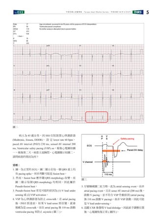 No.033 THRS 5中華民國心律醫學會 ‧Taiwan Heart Rhythm Soclety‧ 中華民國 108 年 4 月出刊
　　病人為 85 歲女性，因 SSS 住院裝置心律調節器
(Medtronic, Ensura, DDDR)， 設 定 lower rate 60 bpm，
paced AV interval (PAVI) 230 ms, sensed AV internal 200
ms, Ventricular safety pacing (VSP) on，術後心電圖如圖
一，術後第二天，病患主述胸悶，心電圖顯示如圖二，
請問病患的情況為何 ?
分析 :
1. 圖一為正常的 ECG。圖二顯示在每一個 QRS 波上均
有 pacing spike，初步判斷可能是 fusion beat。
2. 然而，fusion beat 應伴隨 QRS morphology 改變，而
圖二顯示每個 QRS morphology 均相同，因此屬於
Pseudo-fusion beat。
3. Pseudo-fusion beat 常見可能的原因為 (1) V lead under
sensing 或 (2) VSP activation。
4. VSP 為心律調節器為防止 cross-talk，在 atrial pacing
後，PAVI 到達前，如果 V lead sense 到信號，就會
被視為是 cross-talk，而在 atrial pacing 後 110 ms 啟動
ventricular pacing 來防止 asystole ( 圖三 )。
5. 仔細檢視圖二紅方格，此為 atrial sensing event，而非
atrial pacing event，且在 sense AV interval (200 ms) 後，
啟動 V pacing，並不符合 VSP 作動原則 (atrial pacing
後 110 ms 啟動 V pacing)，故非 VSP 啟動，因此可能
是 V lead under-sensing。
6. 追蹤 CXR 後發現 V lead dislodge，因此給予調整位置
後，心電圖恢復正常 ( 圖四 )。
圖二
圖三
 