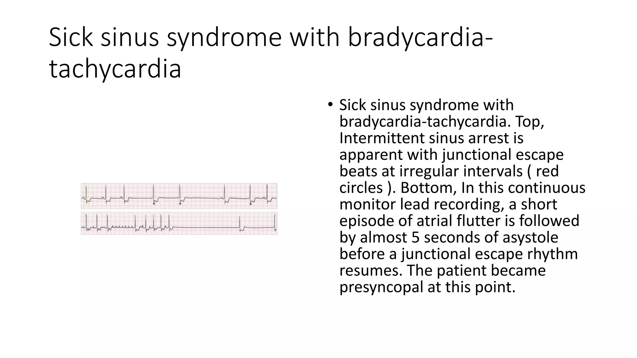 Arrhythmias | PPTX