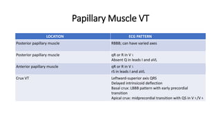 Arrhythmias | PPTX