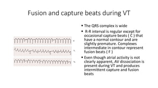 Arrhythmias | PPTX