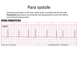 Para systole
secondary pacemaker in the heart, which works in parallel with the SA node.
Parasystolic pacemakers are protected from depolarization by the SA node by
some kind of entrance block.
 