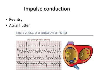 Impulse conduction
• Reentry
• Atrial flutter
 