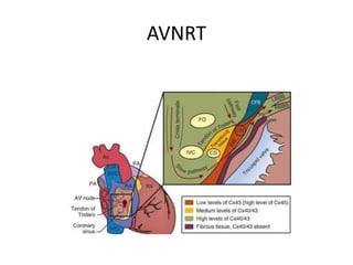 AVNRT
 