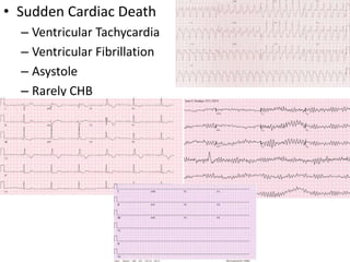 • Sudden Cardiac Death
– Ventricular Tachycardia
– Ventricular Fibrillation
– Asystole
– Rarely CHB
 