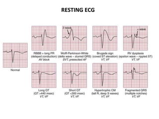 RESTING ECG
 