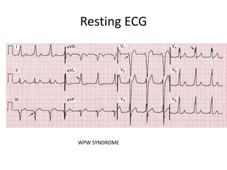 Resting ECG
WPW SYNDROME
 