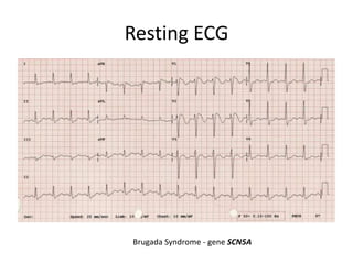 Resting ECG
Brugada Syndrome - gene SCN5A
 