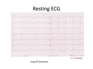 Resting ECG
Long QT Syndrome
 
