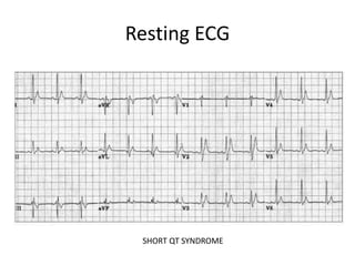 Resting ECG
SHORT QT SYNDROME
 