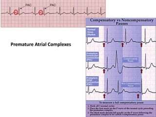 Premature Atrial Complexes
 