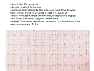 o Rate 250 to 350 beats/min
o Regular, sawtooth flutter waves
o Continual electrical activity (lack of an isoelectric interval between
flutter waves), often best visualized in leads II, III, aVF, or V1
o flutter waves for the most common form, counterclockwise typical
atrial flutter, are inverted (negative) in these leads
o ratio of flutter waves to conducted ventricular complexes is most often
an even number (e.g., 2 : 1, 4 :1)
 