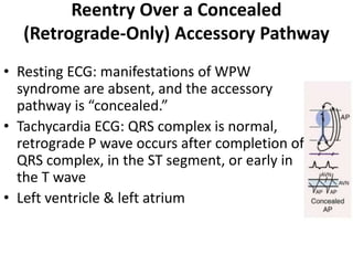 Reentry Over a Concealed
(Retrograde-Only) Accessory Pathway
• Resting ECG: manifestations of WPW
syndrome are absent, and the accessory
pathway is “concealed.”
• Tachycardia ECG: QRS complex is normal,
retrograde P wave occurs after completion of
QRS complex, in the ST segment, or early in
the T wave
• Left ventricle & left atrium
 