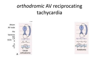 orthodromic AV reciprocating
tachycardia
 