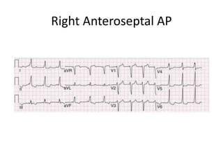 Right Anteroseptal AP
 
