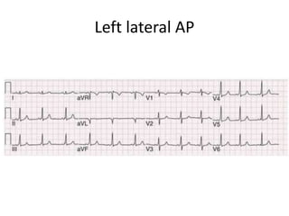 Left lateral AP
 