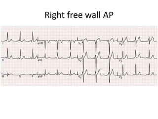Right free wall AP
 
