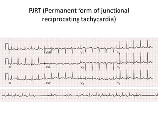 PJRT (Permanent form of junctional
reciprocating tachycardia)
 