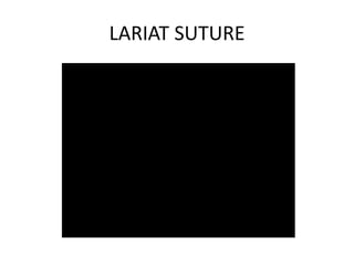 LARIAT SUTURE
 