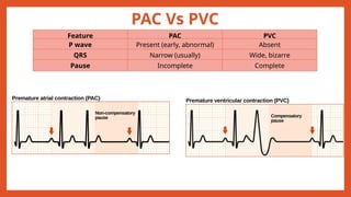 Block Pac Vs. Pvc General Cardiac Arrhythmia and their Management | PPTX