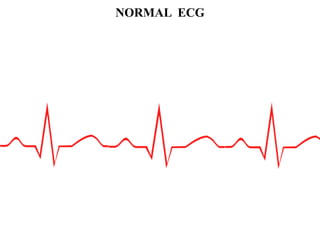 ARRHYTHMIAS ,causes, abnormal impulse conduction, | PDF