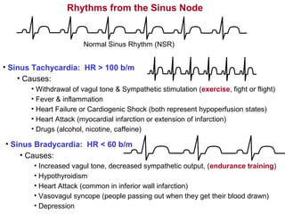 Rhythms from the Sinus Node
Normal Sinus Rhythm (NSR)
• Sinus Tachycardia: HR > 100 b/m
• Causes:
• Withdrawal of vagul tone & Sympathetic stimulation (exercise, fight or flight)
• Fever & inflammation
• Heart Failure or Cardiogenic Shock (both represent hypoperfusion states)
• Heart Attack (myocardial infarction or extension of infarction)
• Drugs (alcohol, nicotine, caffeine)
• Sinus Bradycardia: HR < 60 b/m
• Causes:
• Increased vagul tone, decreased sympathetic output, (endurance training)
• Hypothyroidism
• Heart Attack (common in inferior wall infarction)
• Vasovagul syncope (people passing out when they get their blood drawn)
• Depression
 