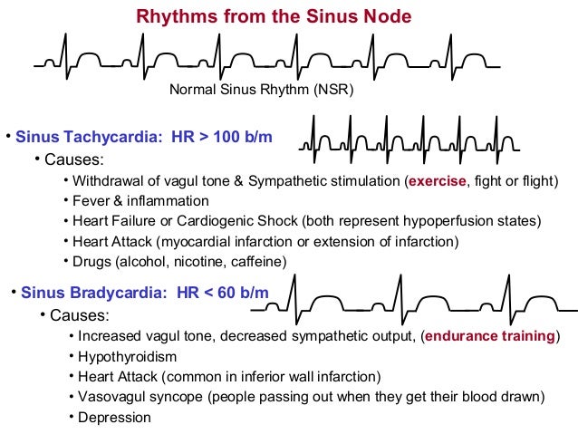 Arrhythmias19 Arrhythmias19