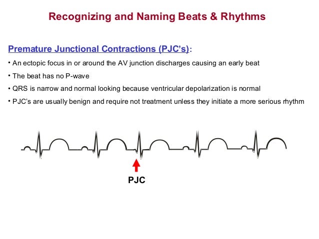 Arrhythmias19
