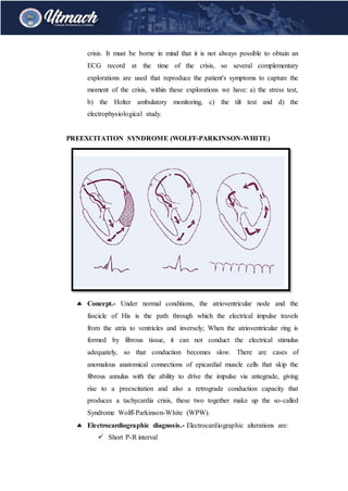 crisis. It must be borne in mind that it is not always possible to obtain an
ECG record at the time of the crisis, so several complementary
explorations are used that reproduce the patient's symptoms to capture the
moment of the crisis, within these explorations we have: a) the stress test,
b) the Holter ambulatory monitoring, c) the tilt test and d) the
electrophysiological study.
PREEXCITATION SYNDROME (WOLFF-PARKINSON-WHITE)
 Concept.- Under normal conditions, the atrioventricular node and the
fascicle of His is the path through which the electrical impulse travels
from the atria to ventricles and inversely; When the atrioventricular ring is
formed by fibrous tissue, it can not conduct the electrical stimulus
adequately, so that conduction becomes slow. There are cases of
anomalous anatomical connections of epicardial muscle cells that skip the
fibrous annulus with the ability to drive the impulse via antegrade, giving
rise to a preexcitation and also a retrograde conduction capacity that
produces a tachycardia crisis, these two together make up the so-called
Syndrome Wolff-Parkinson-White (WPW).
 Electrocardiographic diagnosis.- Electrocardiographic alterations are:
 Short P-R interval
 