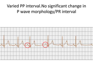 Varied PP interval.No significant change in
P wave morphology/PR interval
 