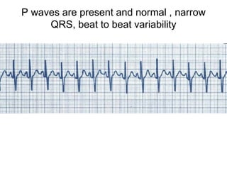 P waves are present and normal , narrow
QRS, beat to beat variability
 