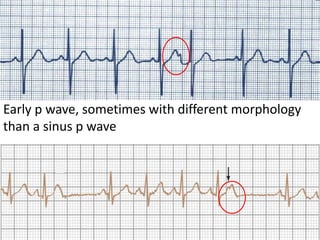 Early p wave, sometimes with different morphology
than a sinus p wave
 