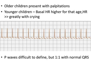 • Older children present with palpitations
• Younger children – Basal HR higher for that age,HR
>> greatly with crying
• P waves difficult to define, but 1:1 with normal QRS
 
