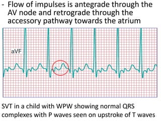 - Flow of impulses is antegrade through the
AV node and retrograde through the
accessory pathway towards the atrium
SVT in a child with WPW showing normal QRS
complexes with P waves seen on upstroke of T waves
 