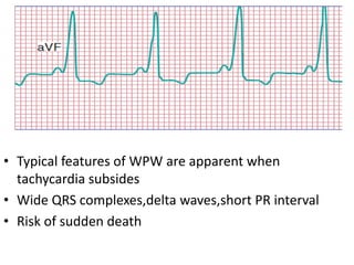 • Typical features of WPW are apparent when
tachycardia subsides
• Wide QRS complexes,delta waves,short PR interval
• Risk of sudden death
 