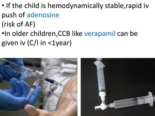 • If the child is hemodynamically stable,rapid iv
push of adenosine
(risk of AF)
•In older children,CCB like verapamil can be
given iv (C/I in <1year)
 