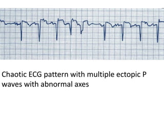 Chaotic ECG pattern with multiple ectopic P
waves with abnormal axes
 